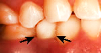 a dental implant inside the mouth.