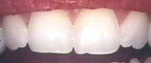 tooth shaping
