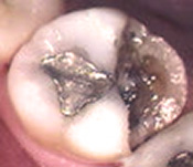 a siler filling in the tooth