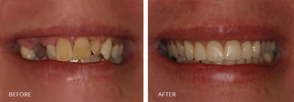 before vs. after smile
