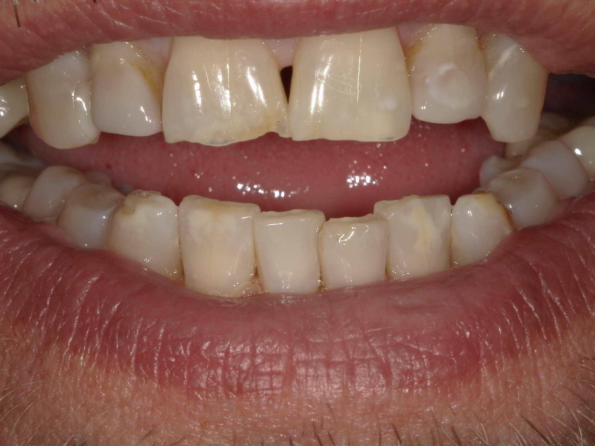 Before close-up photo of chipped teeth