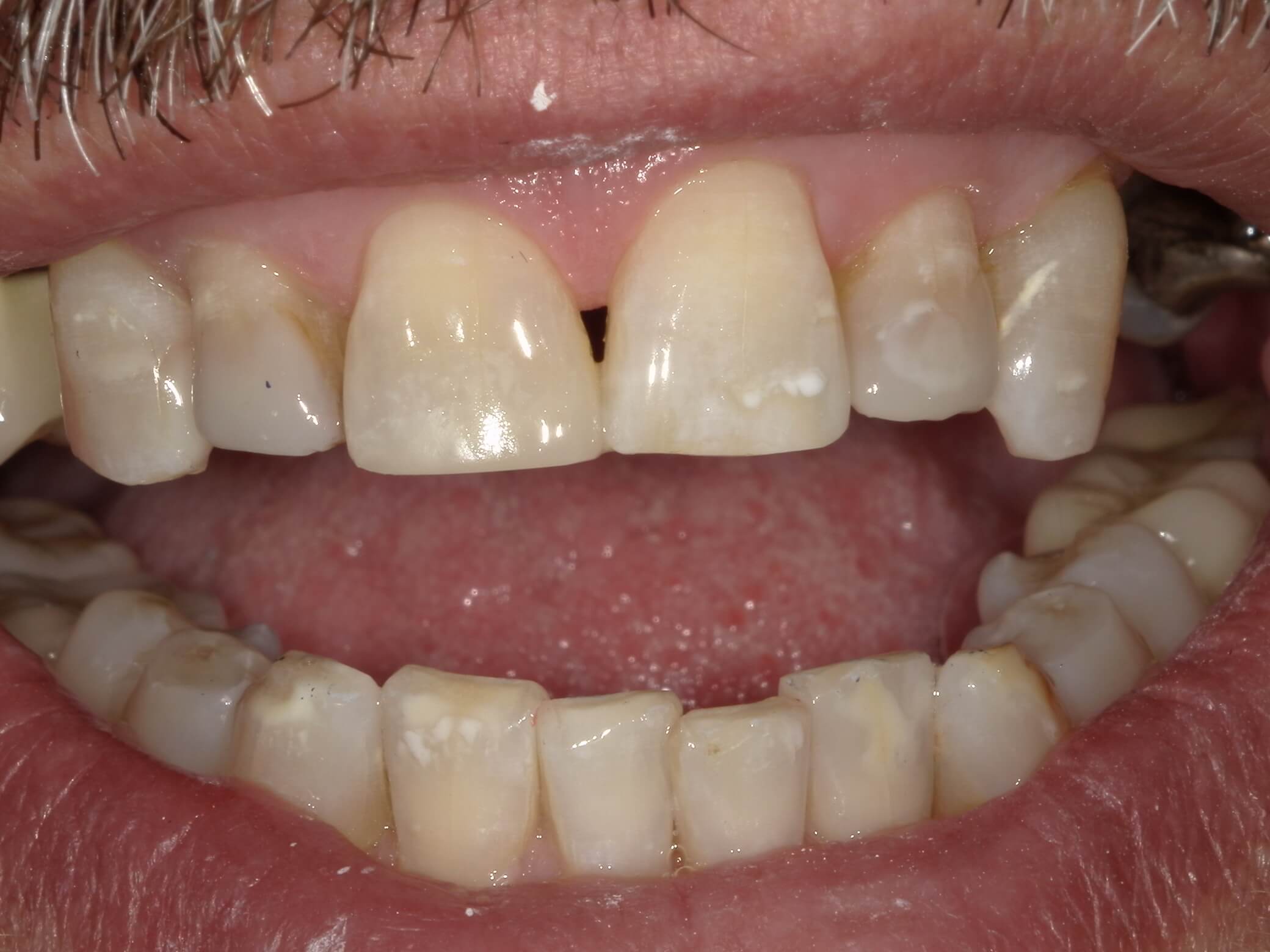 After close-up picture of teeth filled in with composite fillings