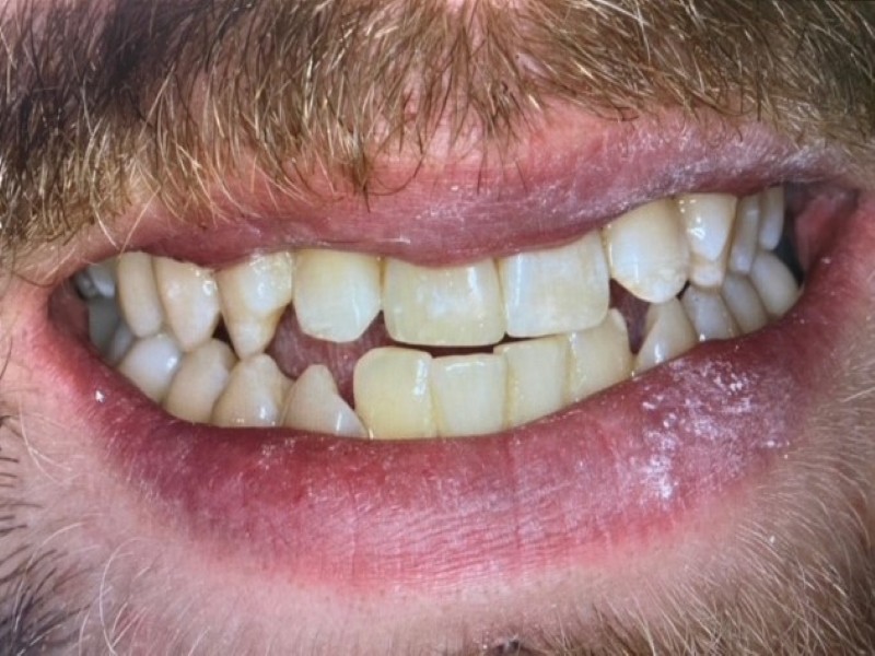 After picture of fixed front tooth