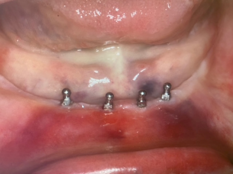 Photo of four mini dental implants placed on the lower arch