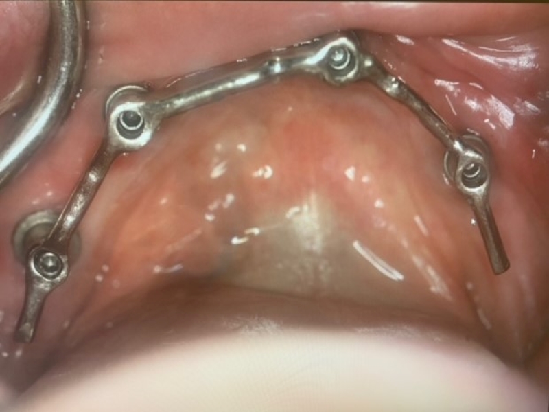 Close up photo of implant fixtures placed
