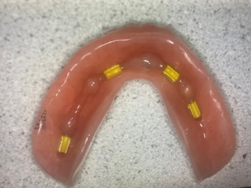 Lower implant-denture restoration