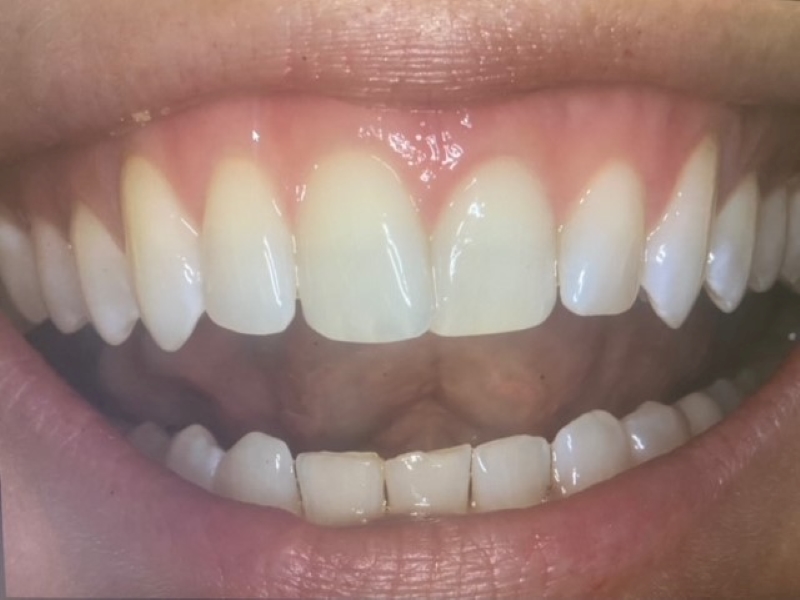 After photo of upper front tooth filled in