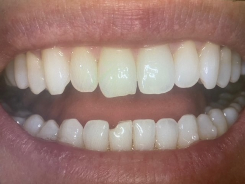 Before picture of lower front chipped tooth