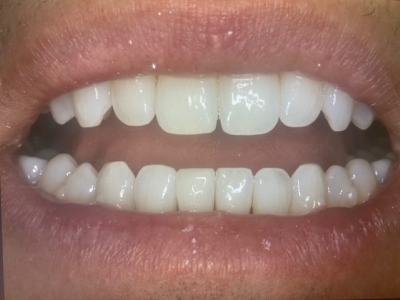 After picture of lower front chipped tooth filled in