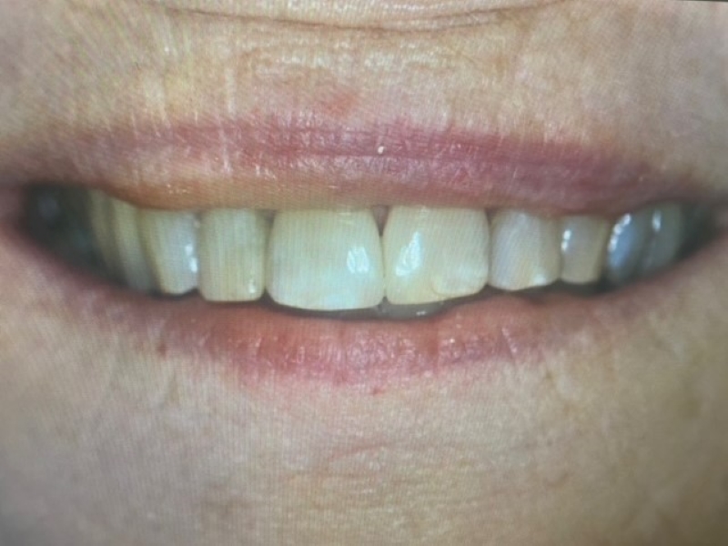 After picture of teeth with composite bonding