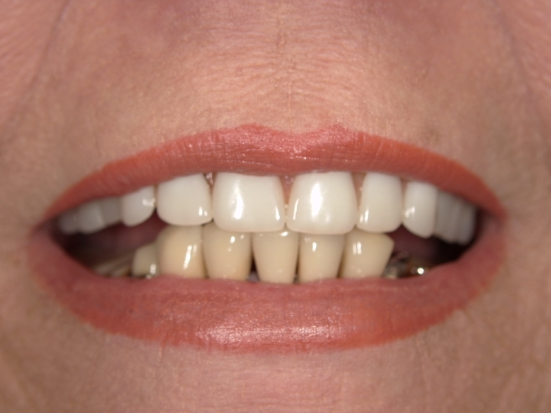 Before photo of lower teeth for lower denture