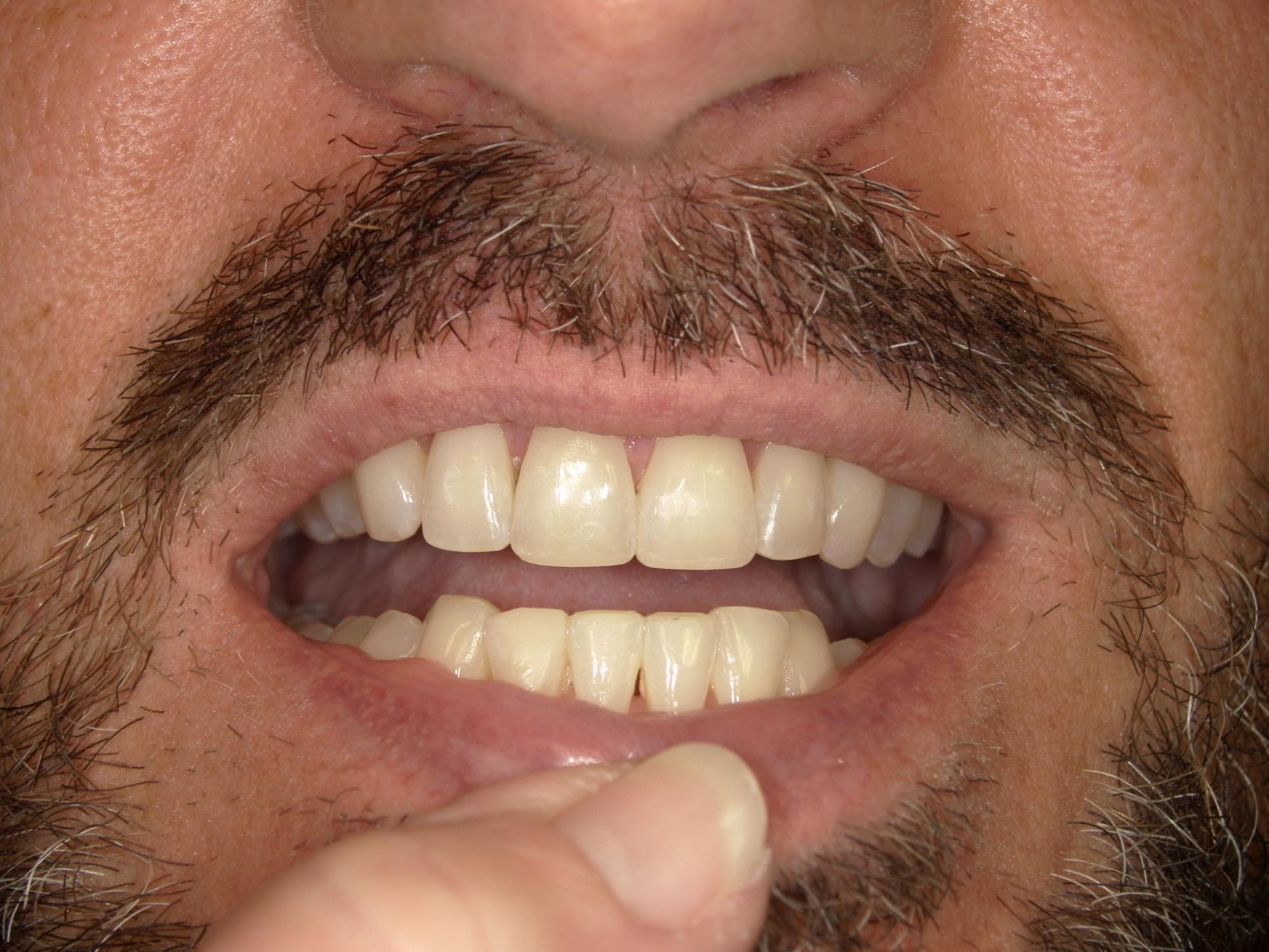 After picture of teeth filled chipped teeth