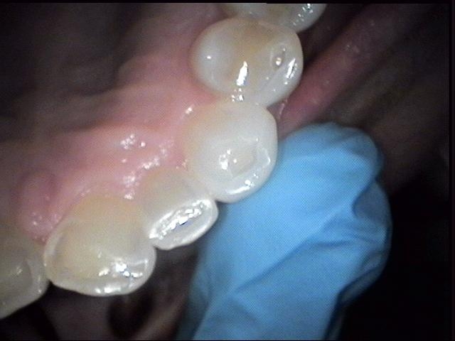 Giambra's grinded teeth
