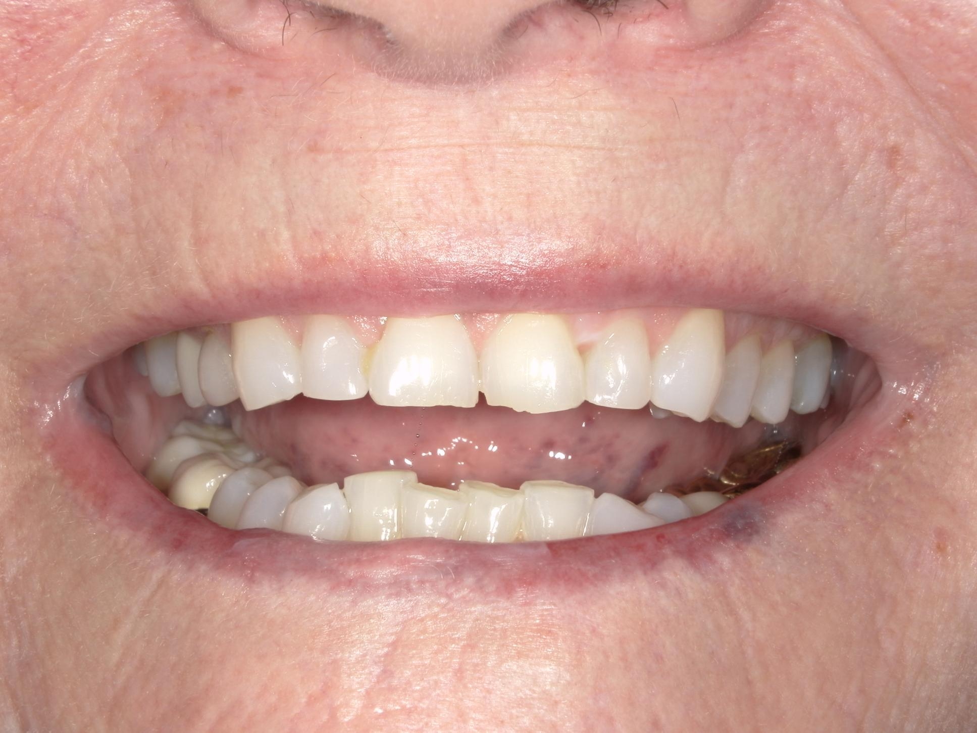 Giambra's before picture of chipped upper front teeth
