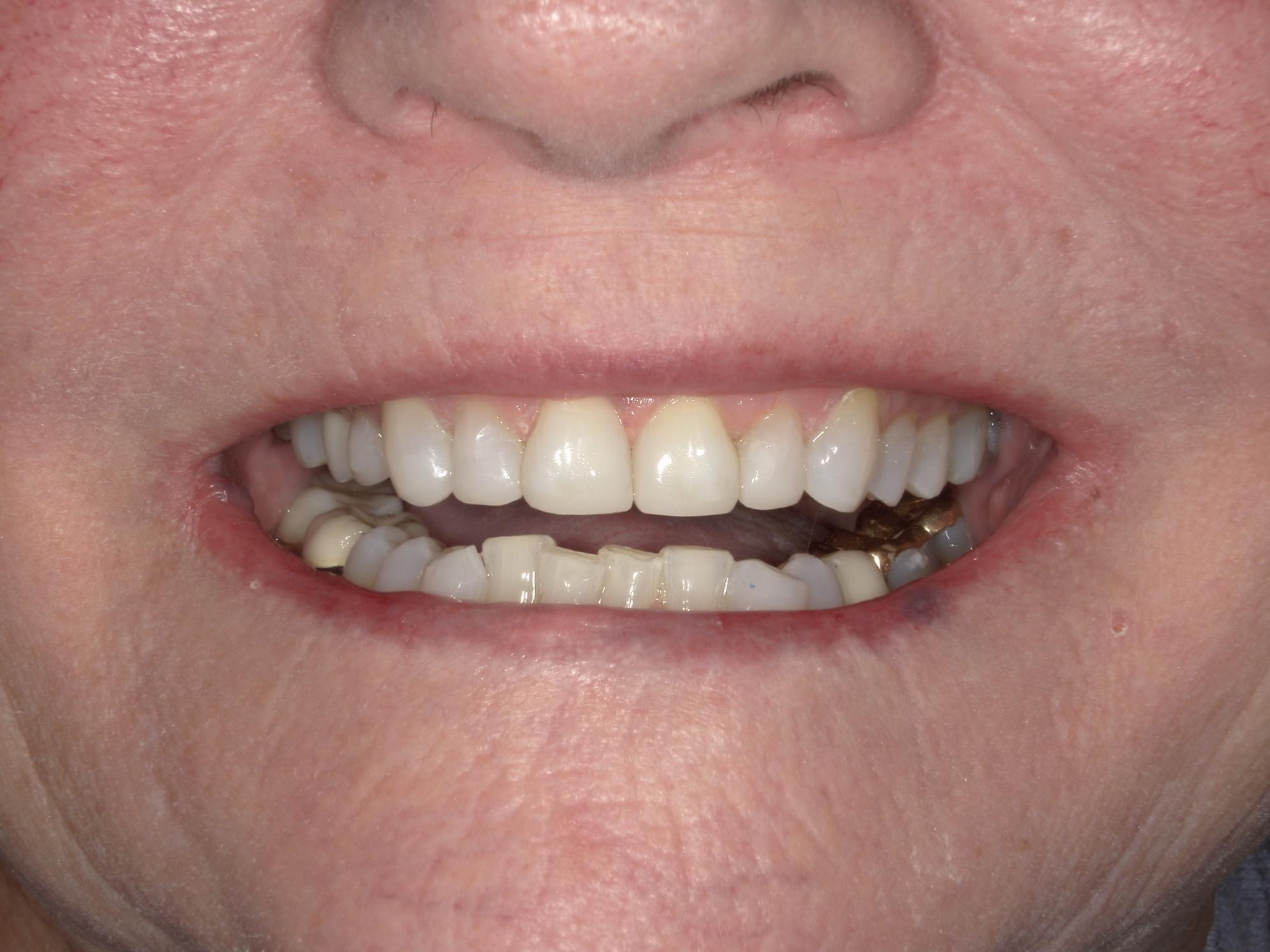 Giambra after picture (teeth showing from the front)