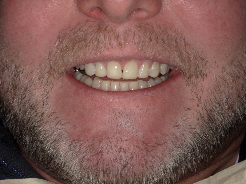 Patient Eric after picture of teeth forward