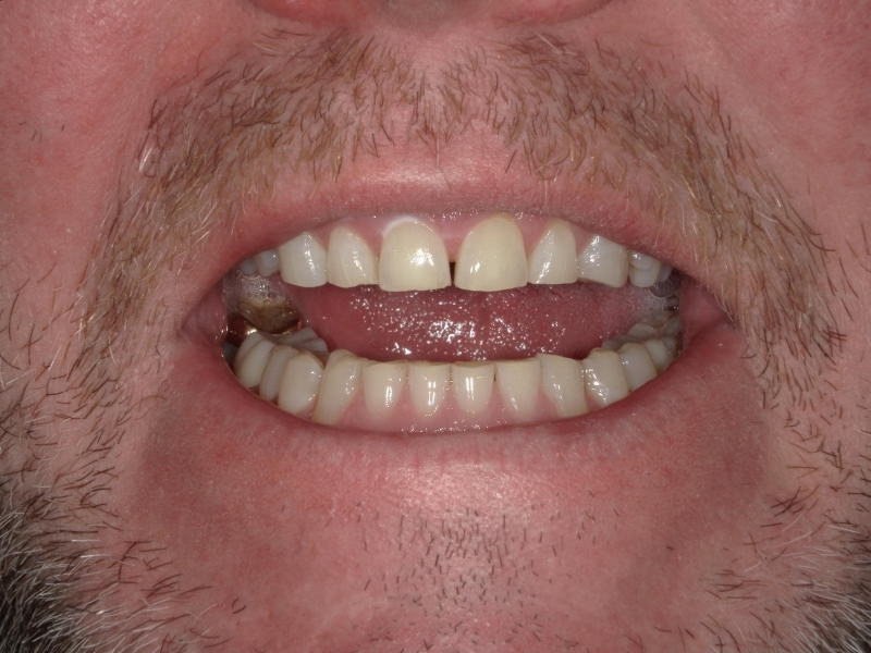 Eric before picture (showing the front teeth)