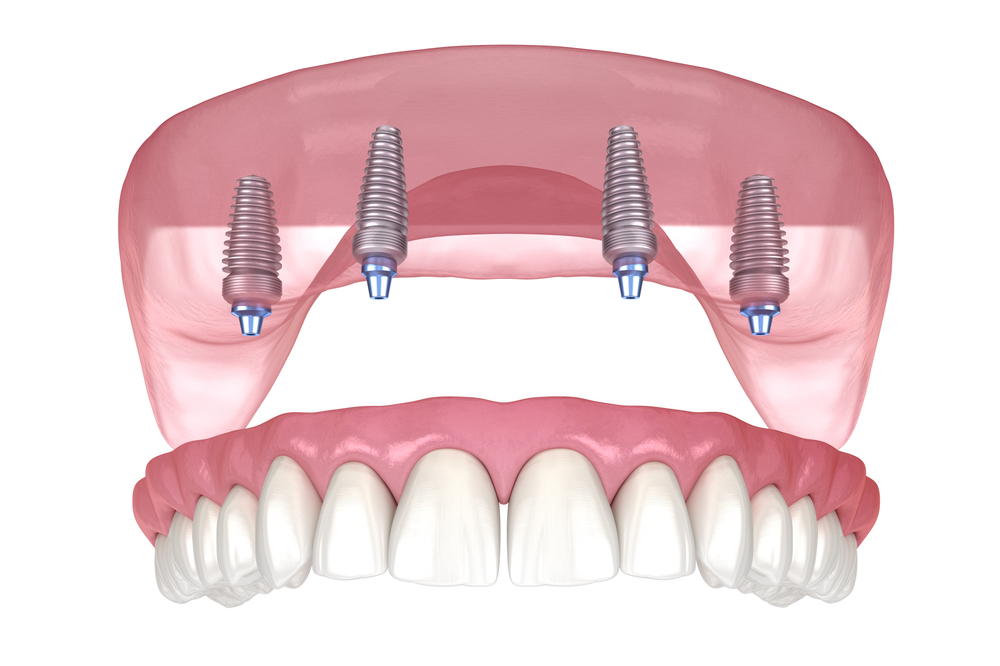 prosthetic-supported by all-on-4 implants