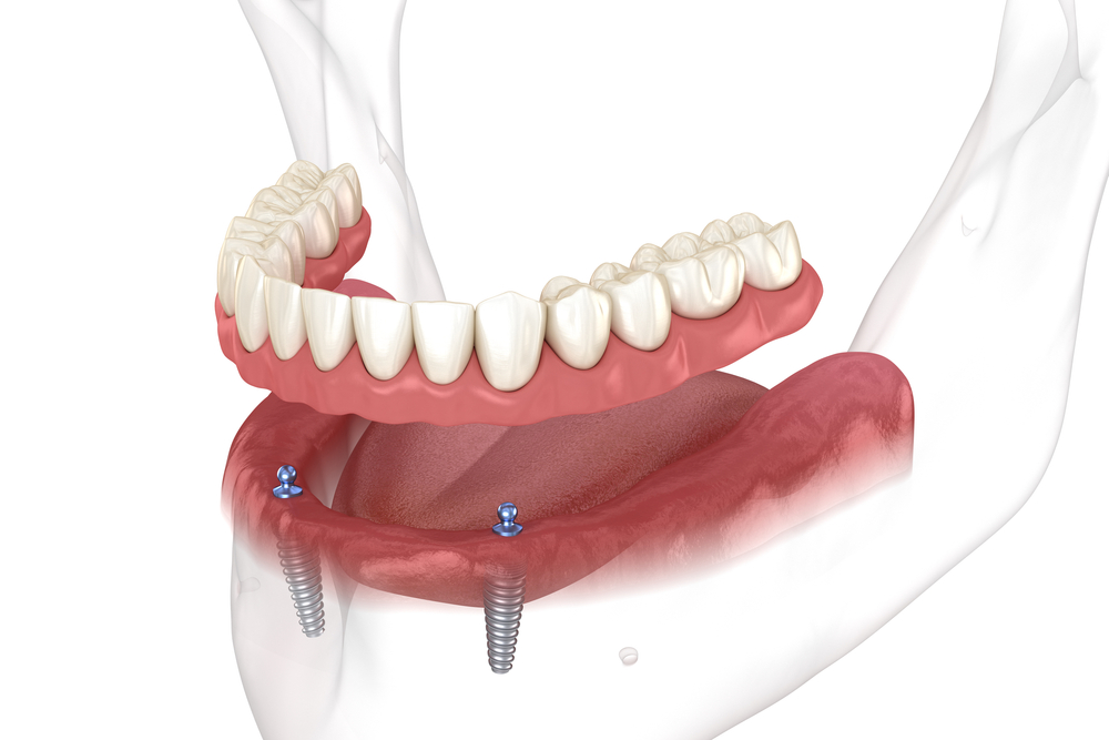 implant-supported dentures