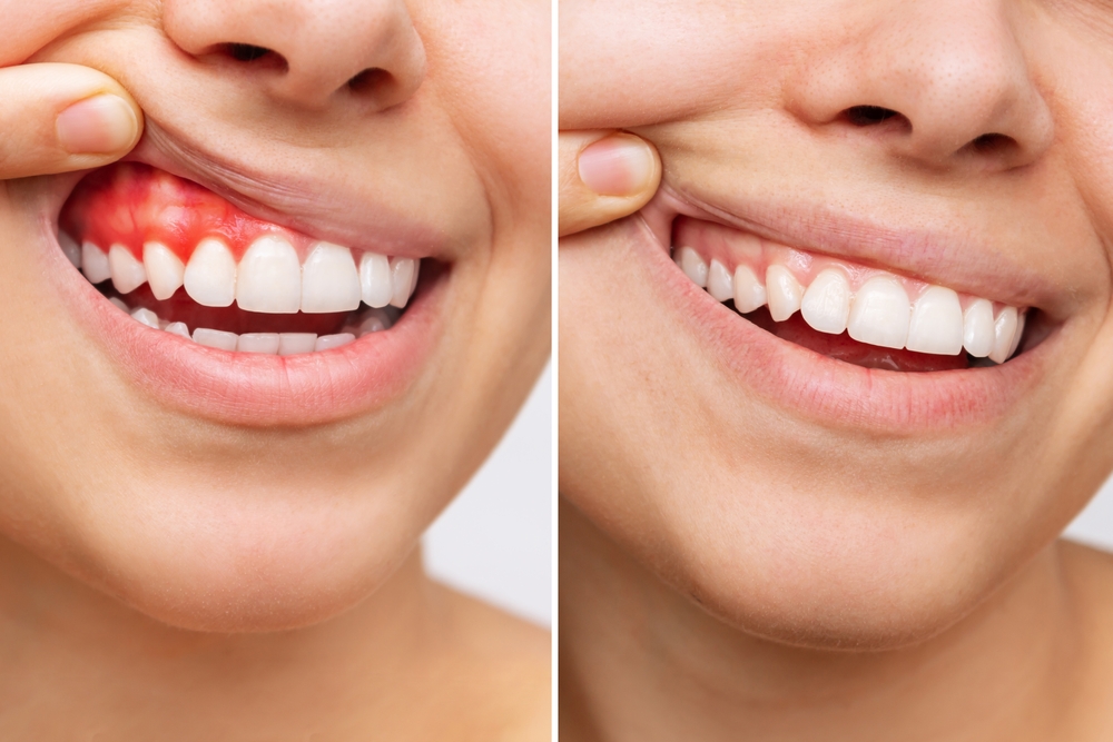 before and after gum disease treatment