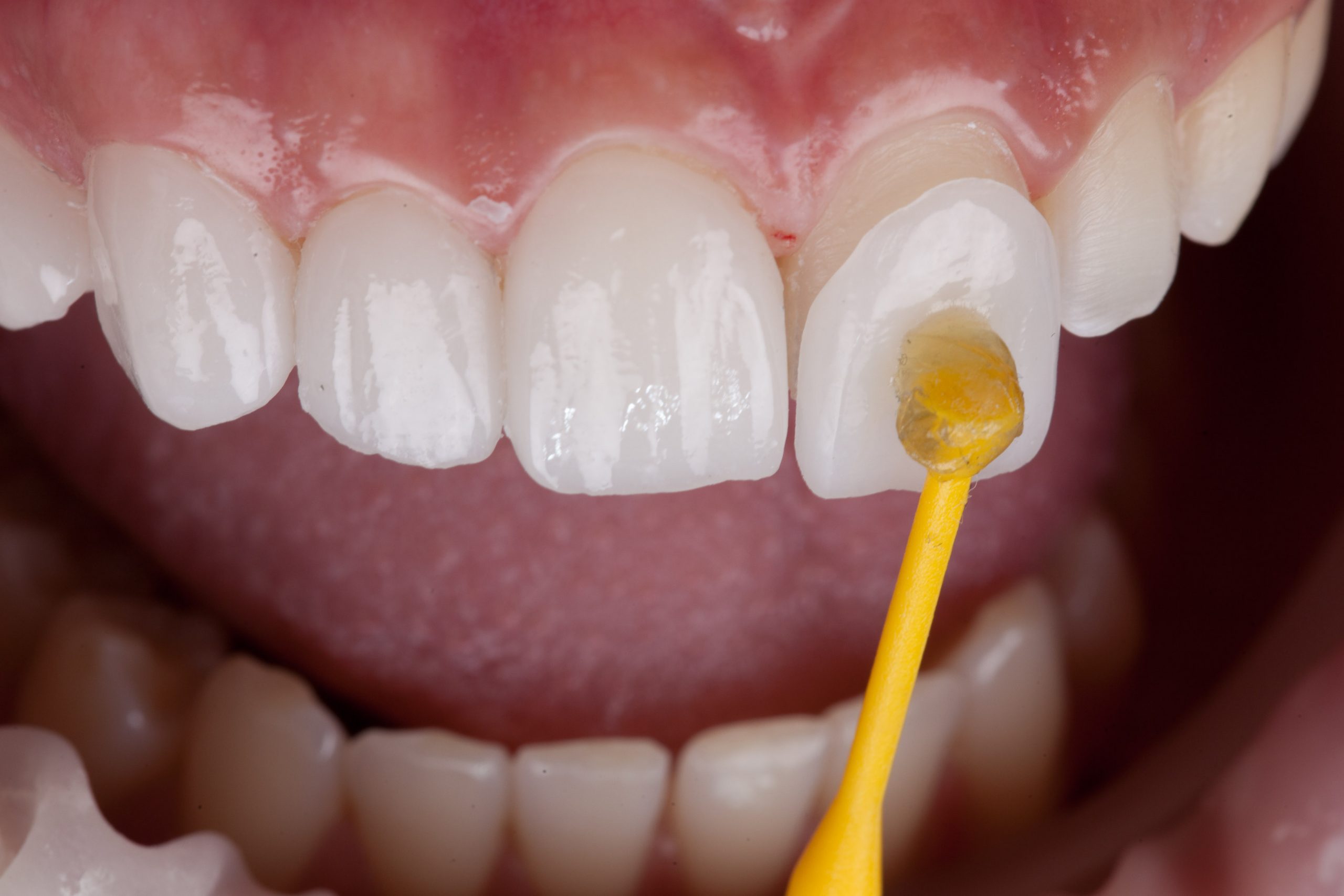 bonding veneers to teeth