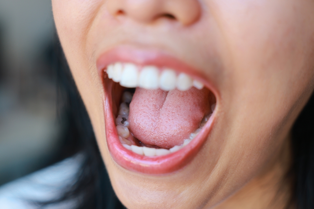 patient with dental cavities