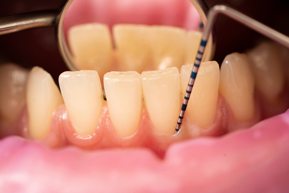 dentist measuring pocket depth